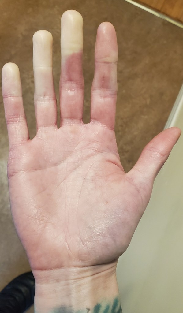 My left hand showing pallor in the pinky, ring, and middle fingers.