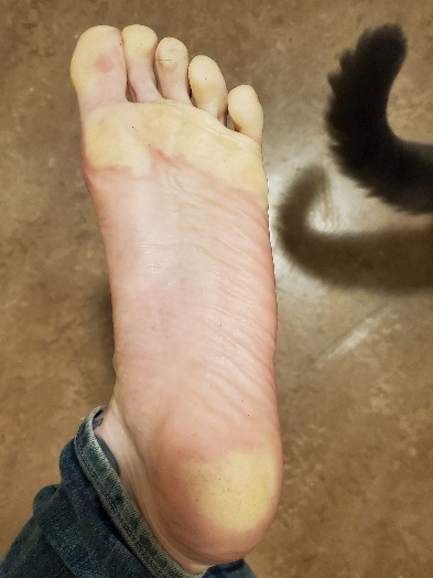 My left foot, showing blanching of the toes, heel, and ball of foot. The tail of a grey cat is visible in the upper right corner.